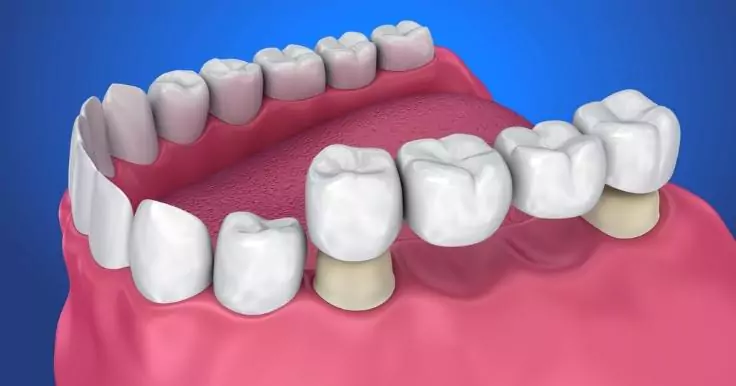 Crowns & Bridges Treatment in Pimpri Chinchwad Dr Lokhande Dental Clinic